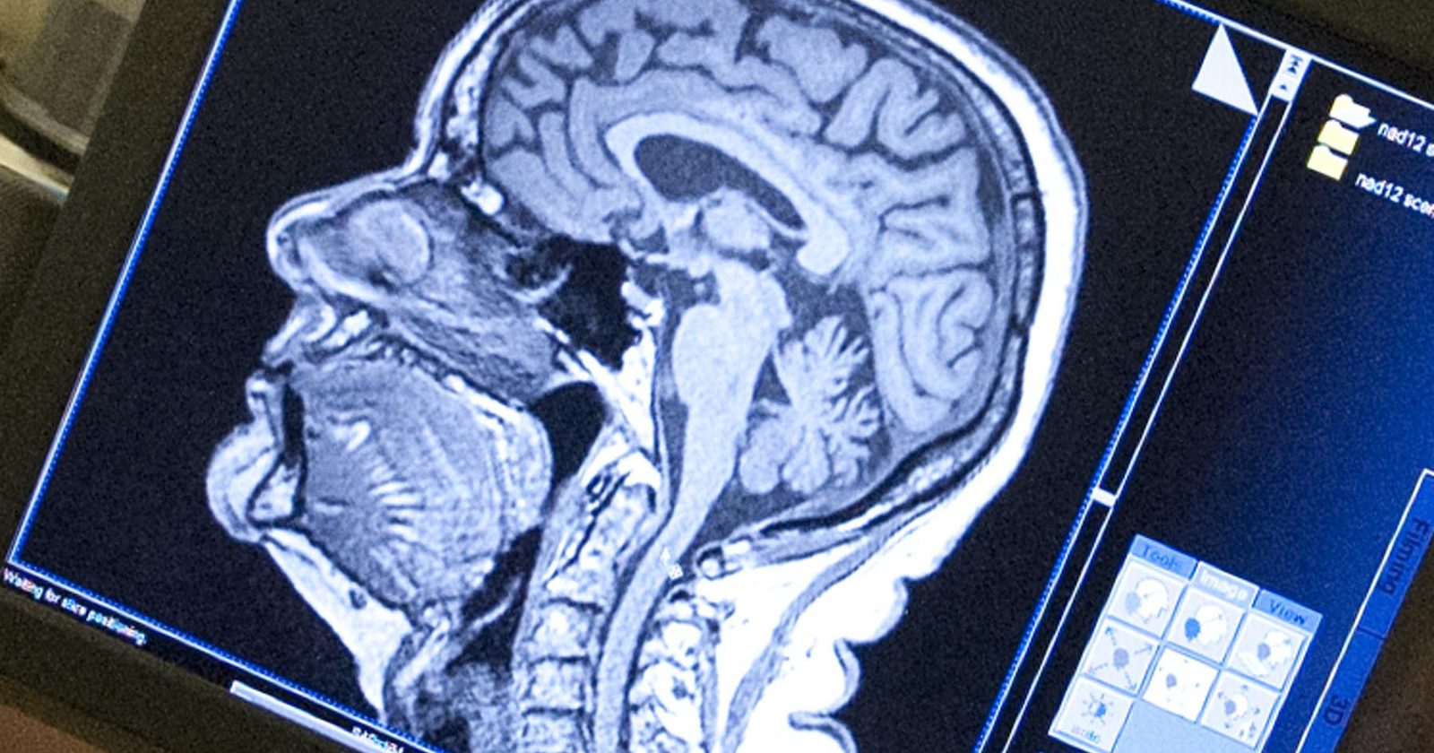 computer monitor with image of brain scan